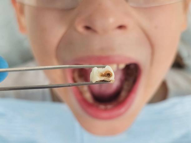 Best Emergency Root Canal Treatment in Gosport, IN