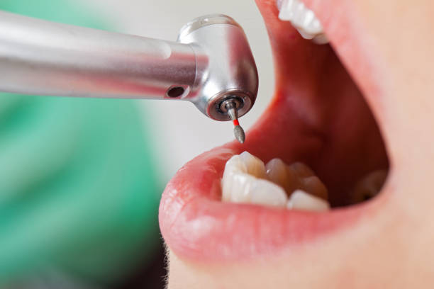 Best Emergency Tooth Extraction in Gosport, IN